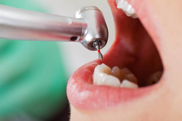 Best Emergency Tooth Extraction in Gustine, CA